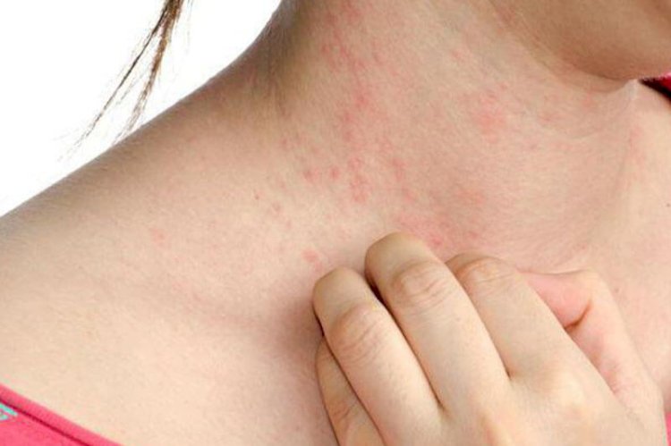 โรคลมพิษ Urticaria